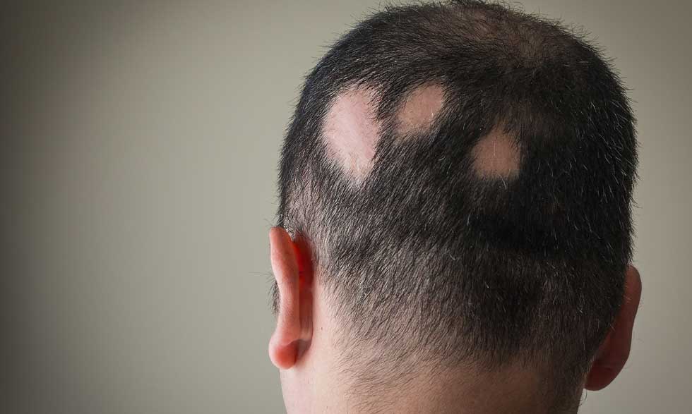 Everything you should know about patchy hair loss (Alopecia Areata)