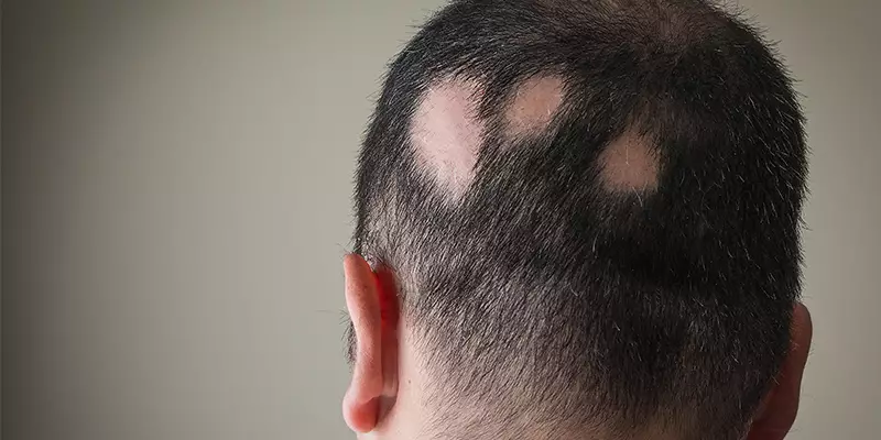 Everything You Should Know About Patchy Hair Loss