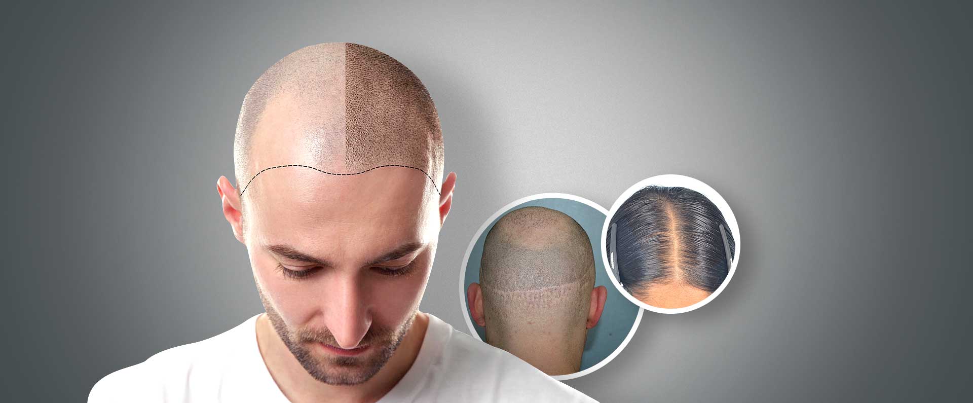 Male Pattern Baldness Solution