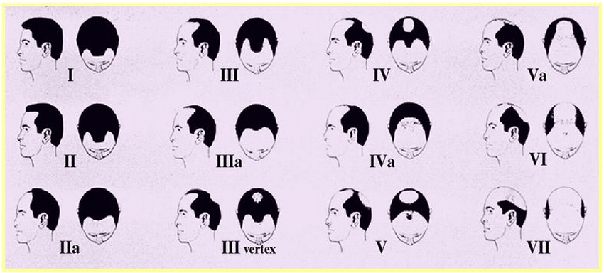 Type I to Type V Norwood-Hamilton Classification