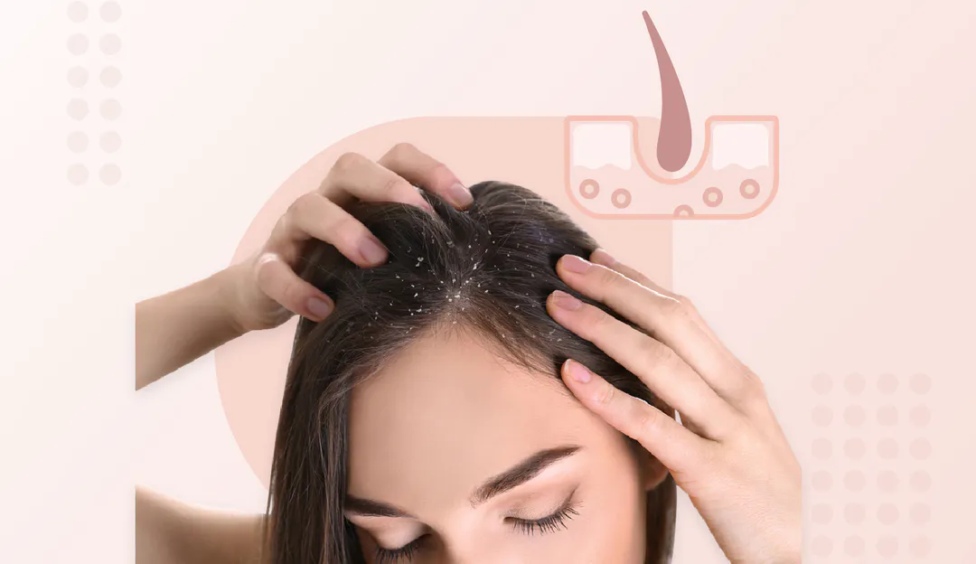 Dandruff Treatment In Kurnool