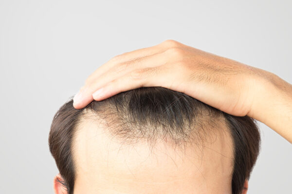 Hair Loss Treatment kurnool