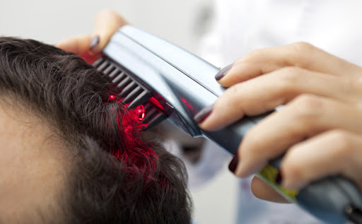 Low-level laser therapy LLLT) for Hair loss