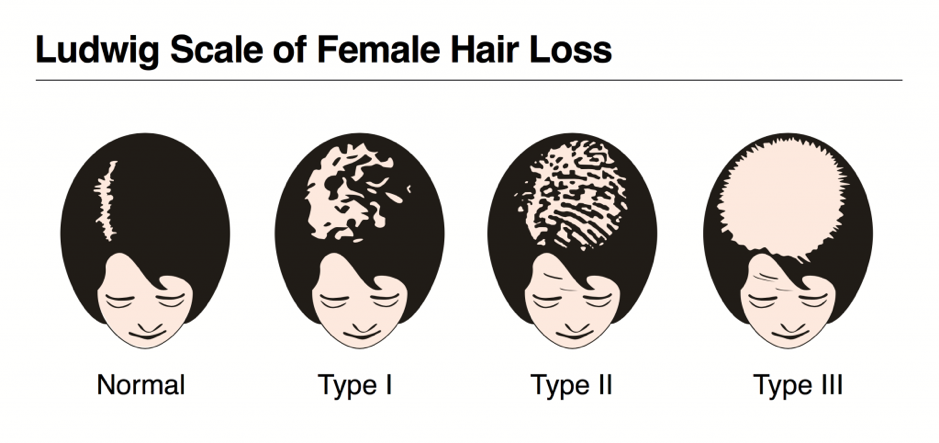 Woman with Type I & II Ludwig scale