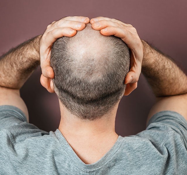 Male hair loss Treatment In Kurnool