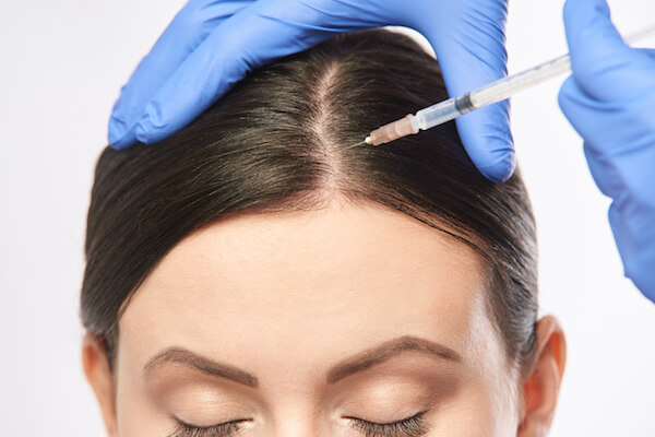 Platelet-Rich Plasma for hair loss