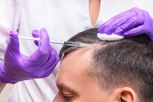 facts about PRP for hair loss treatment