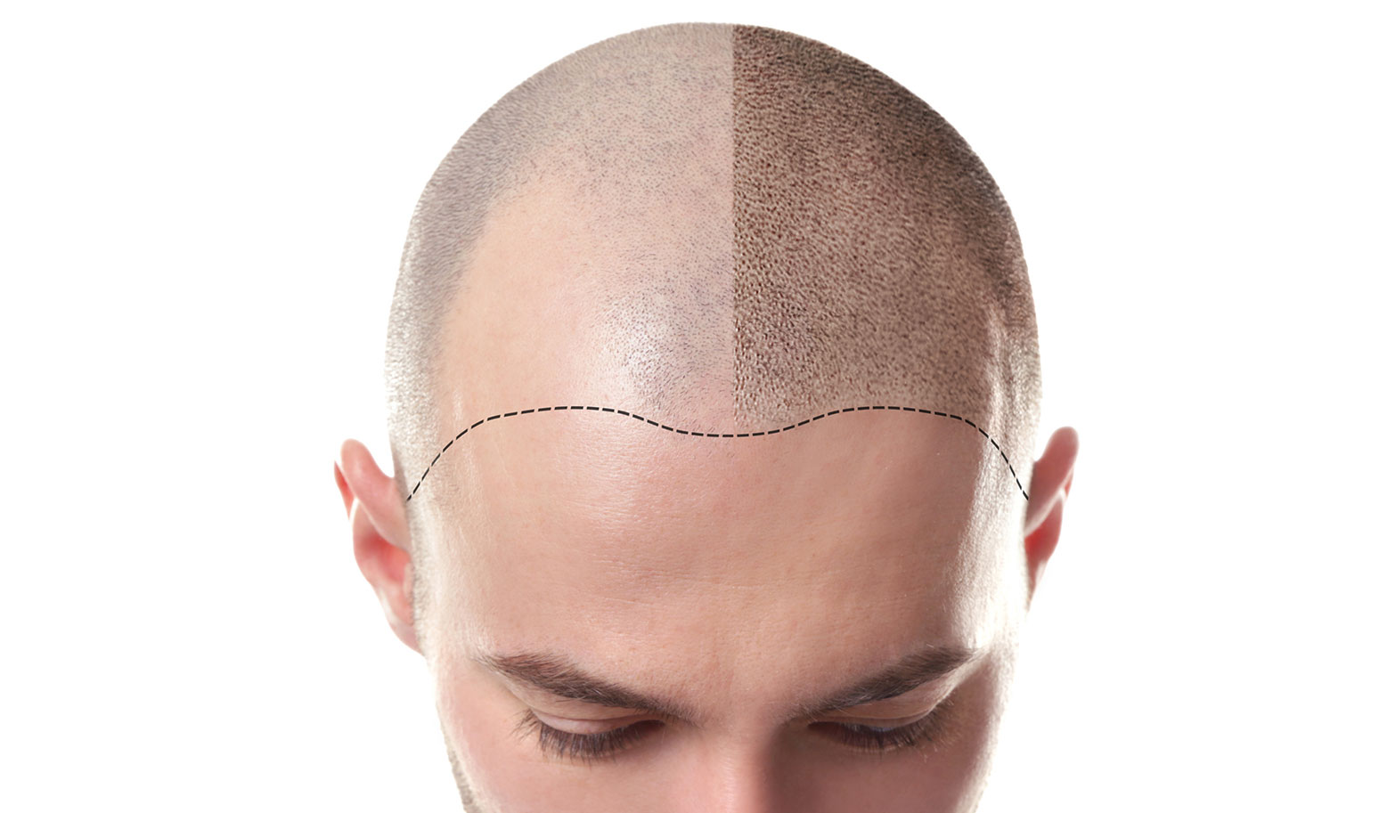 What Is Scalp Micropigmentation?